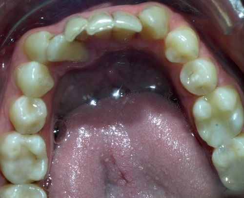 A close up of a person 's teeth with their tongue sticking out.