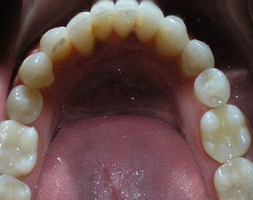 A close up of a person 's teeth with white fillings.