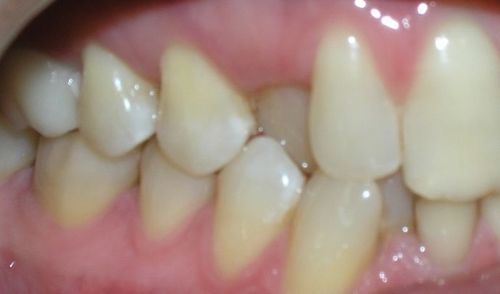 A close up of a person 's teeth and gums