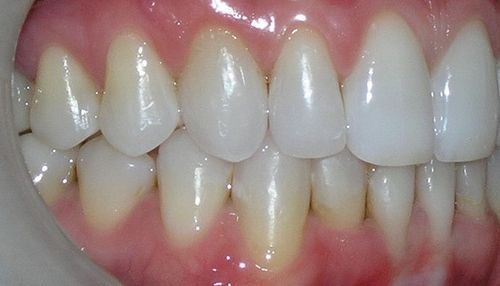 A close up of a person 's teeth with white teeth.