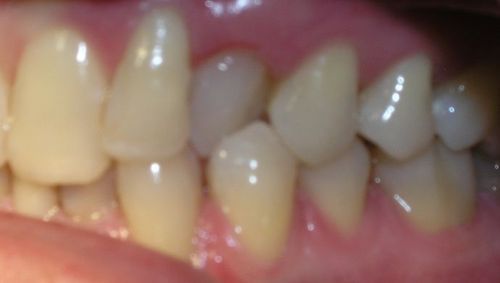 A close up of a person 's teeth and gums