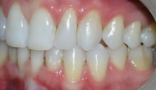 A close up of a person 's teeth with white teeth and red gums.