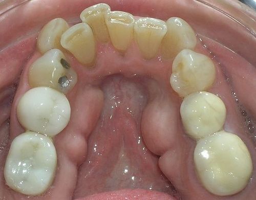 A close up of a person 's mouth with a lot of teeth.