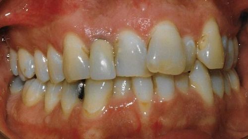 A close up of a person 's teeth with a broken tooth.