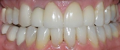 A close up of a person 's teeth with white teeth.