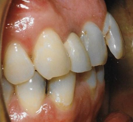 A close up of a person 's teeth and mouth