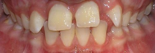 A close up of a person 's teeth and gums.