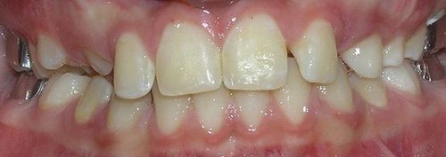 A close up of a person 's teeth with a metal brace.