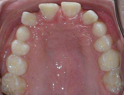A close up of a person 's mouth with their teeth showing.