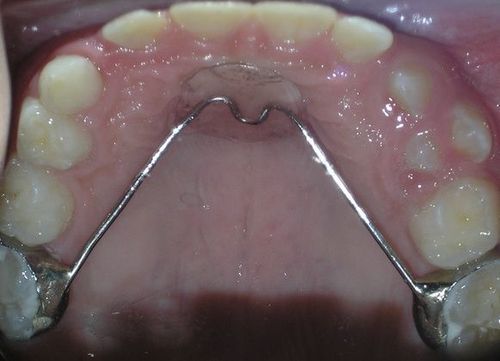 A close up of a person 's mouth with braces on their teeth.