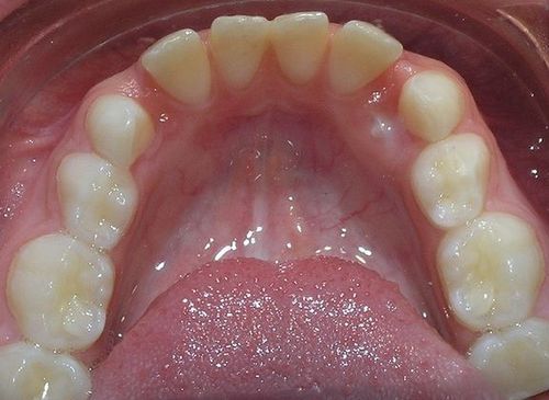 A close up of a person 's teeth with a tongue sticking out.