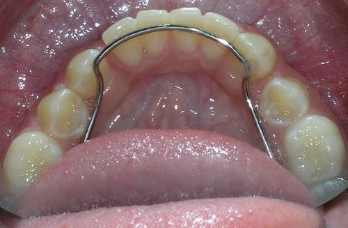 A close up of a person 's mouth with a brace on their teeth.