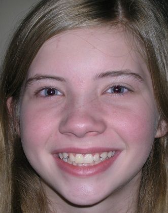 A young girl with braces on her teeth is smiling for the camera.
