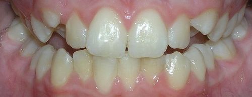A close up of a person 's teeth with a missing tooth.