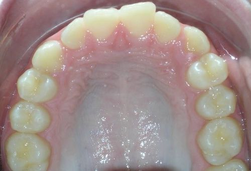A close up of a person 's teeth and mouth.