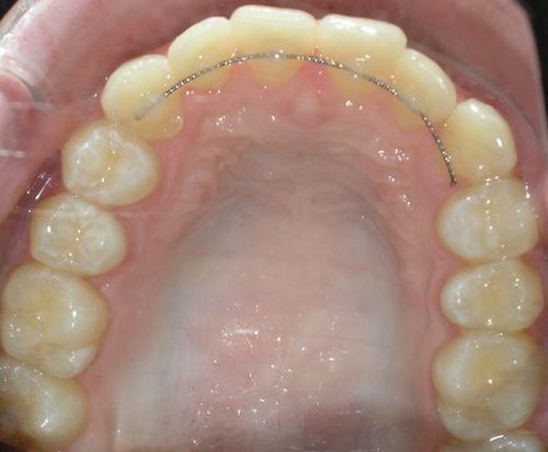 A close up of a person 's teeth with braces on them.