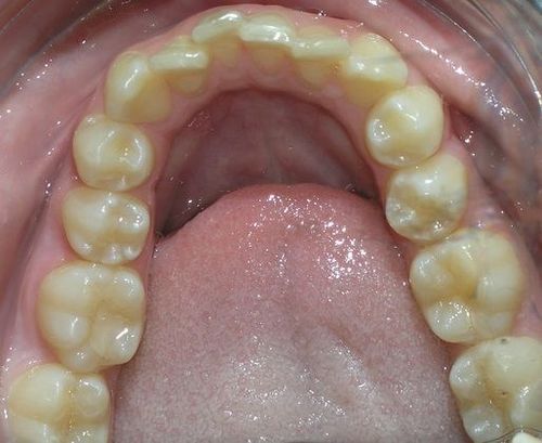 A close up of a person 's teeth with their tongue sticking out.
