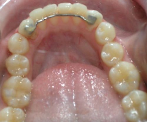 A close up of a person 's teeth with a metal brace