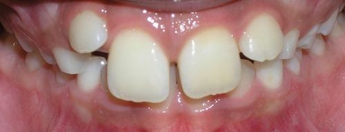 A close up of a person 's teeth with a missing tooth.
