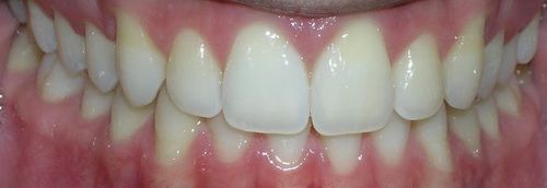 A close up of a person 's teeth with white teeth.