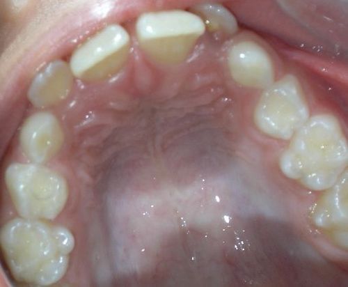 A close up of a person 's teeth with a few missing