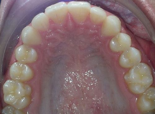 A close up of a person 's teeth with their tongue out.