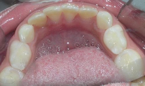 A close up of a person 's teeth and tongue.