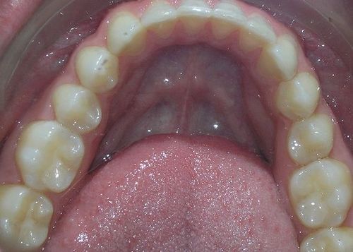 A close up of a person 's teeth and tongue.