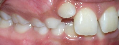 A close up of a person 's mouth with a tooth missing.