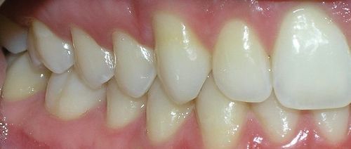 A close up of a person 's teeth and gums.