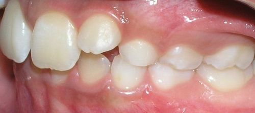 A close up of a person 's teeth and mouth.