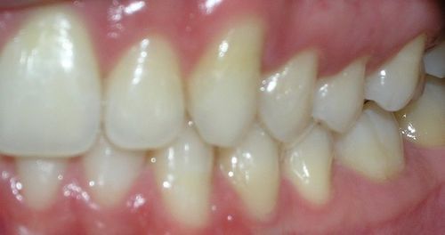 A close up of a person 's teeth and gums.