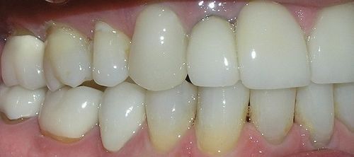 A close up of a person 's teeth with a lot of white teeth.