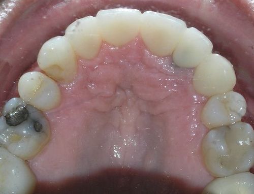 A close up of a person 's mouth with a lot of teeth.