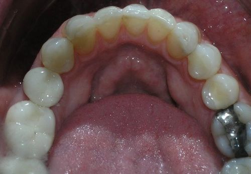 A close up of a person 's mouth with a lot of teeth.