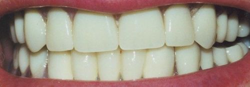 A close up of a person 's teeth with a red lip.