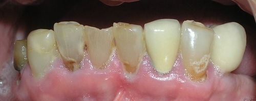 A close up of a person 's teeth with a lot of plaque on them.