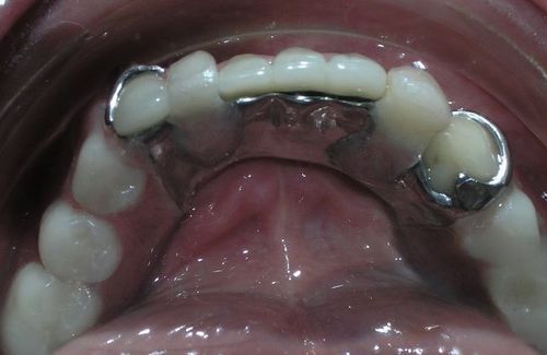 A close up of a person 's teeth with a metal brace.