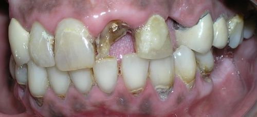 A close up of a person 's teeth with a hole in the middle.