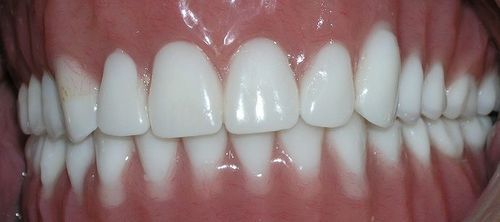 A close up of a person 's teeth with white teeth.