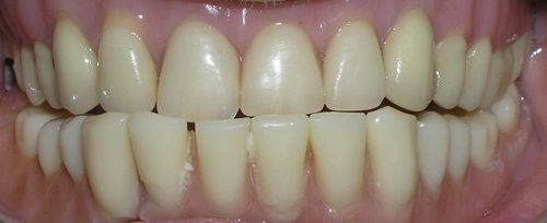 A close up of a person 's teeth with white teeth.