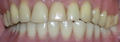 A close up of a person 's teeth with white teeth.