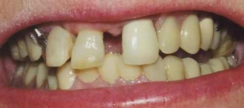A close up of a person 's teeth with a missing tooth.