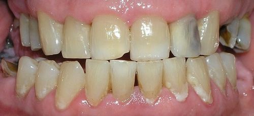 A close up of a person 's teeth with a lot of stains on them.