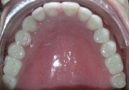 A close up of a person 's mouth with white teeth.