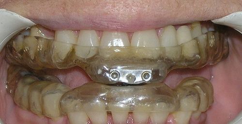 A close up of a person 's mouth with braces on their teeth.