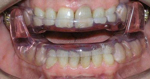A close up of a person 's mouth with braces on their teeth.
