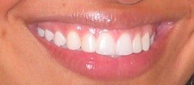 A close up of a woman 's smile with white teeth.