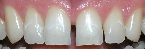 A close up of a person 's teeth with a missing tooth.