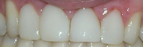 A close up of a person 's teeth with a pink gums.